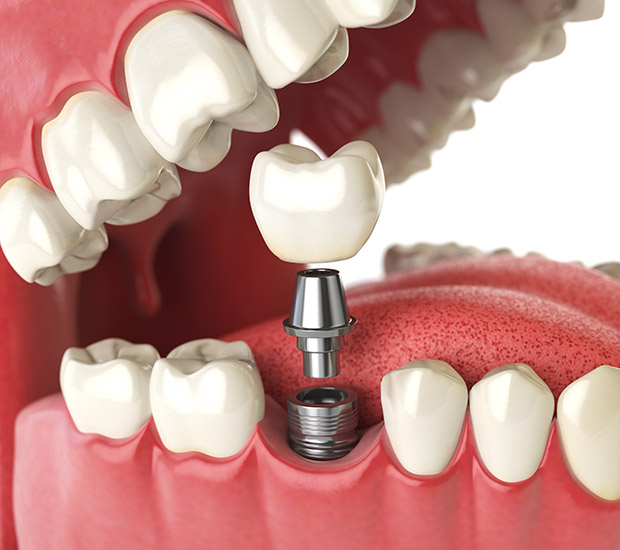 Agoura Hills Will I Need a Bone Graft for Dental Implants