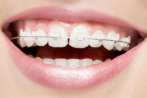 Reasons To Consider Clear Braces