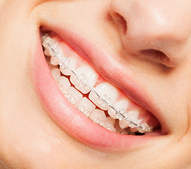 Agoura Hills Clear Braces