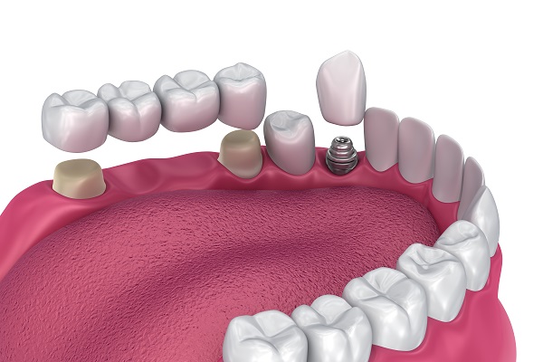 Comparing A Dental Bridge To Dental Implants