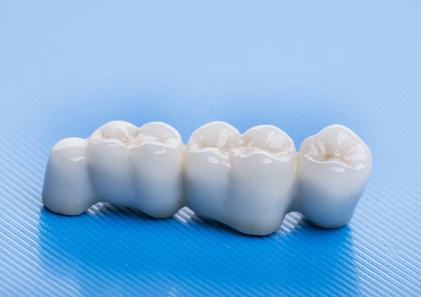 Dental Bridge FAQs