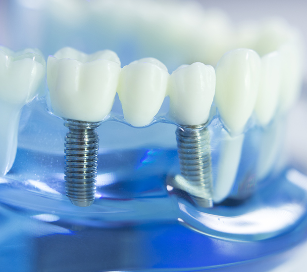 Agoura Hills Dental Implants