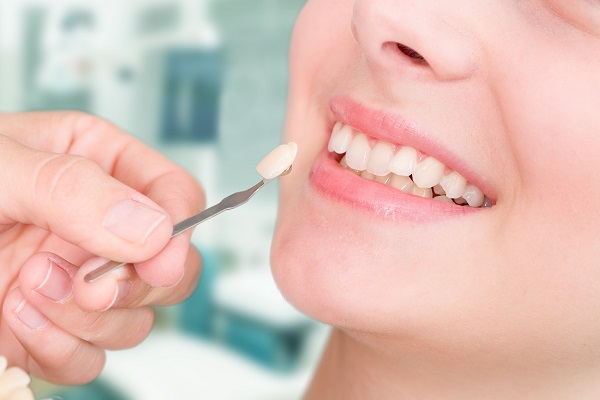 Are Dental Veneers Permanent?